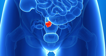 uterine fibroid:Uterine Artery Embolization