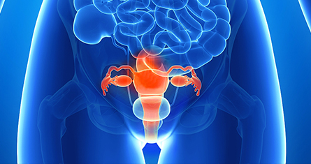 Hysterectomy is the removal of the uterus. The ovaries may or may not be removed. Hysterectomy is done when other treatments have not worked or are not possible or the fibroids are very large. A woman is no longer able to have children after having a hysterectomy.